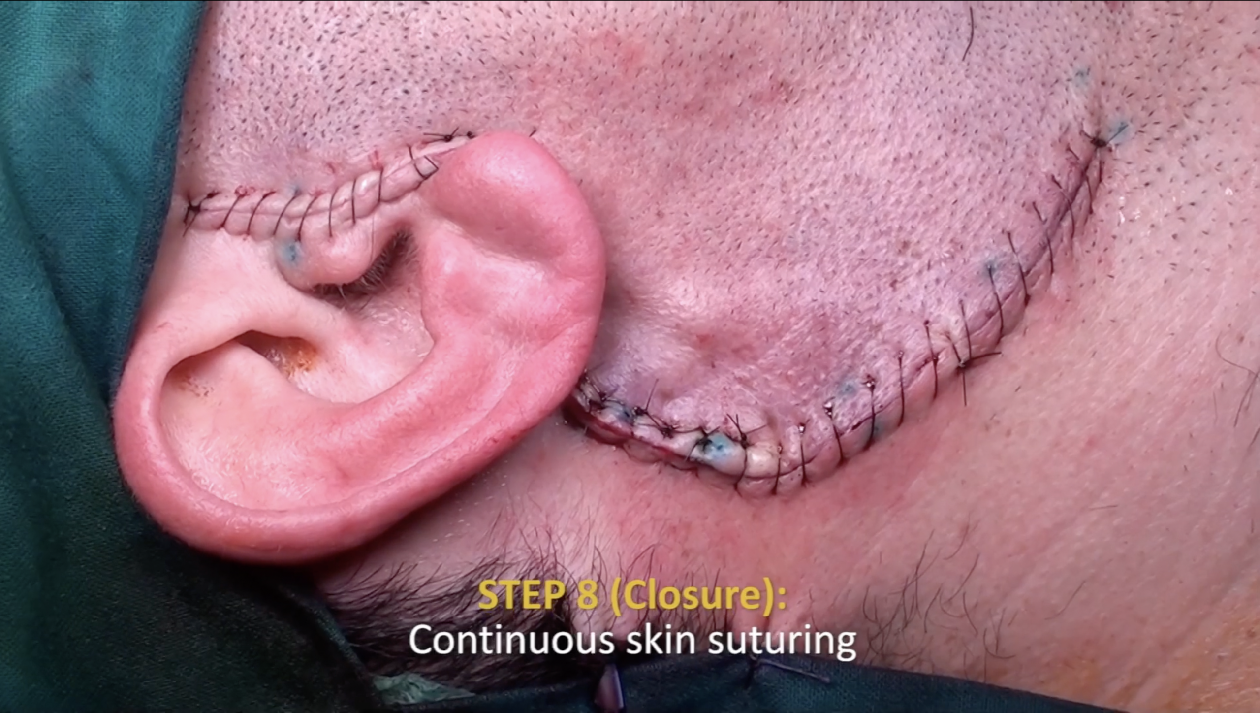 Facial Nerve dissection