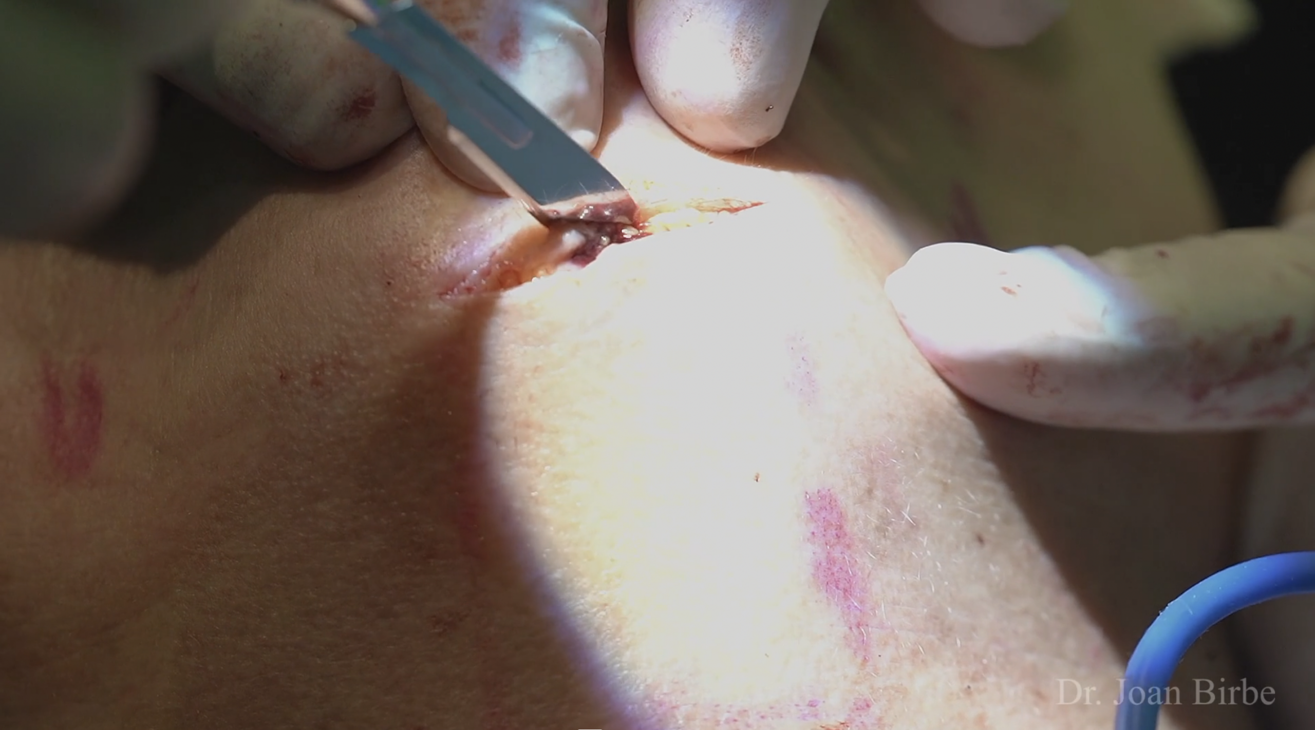 Deep plane face lift – Dr Joan Birbe