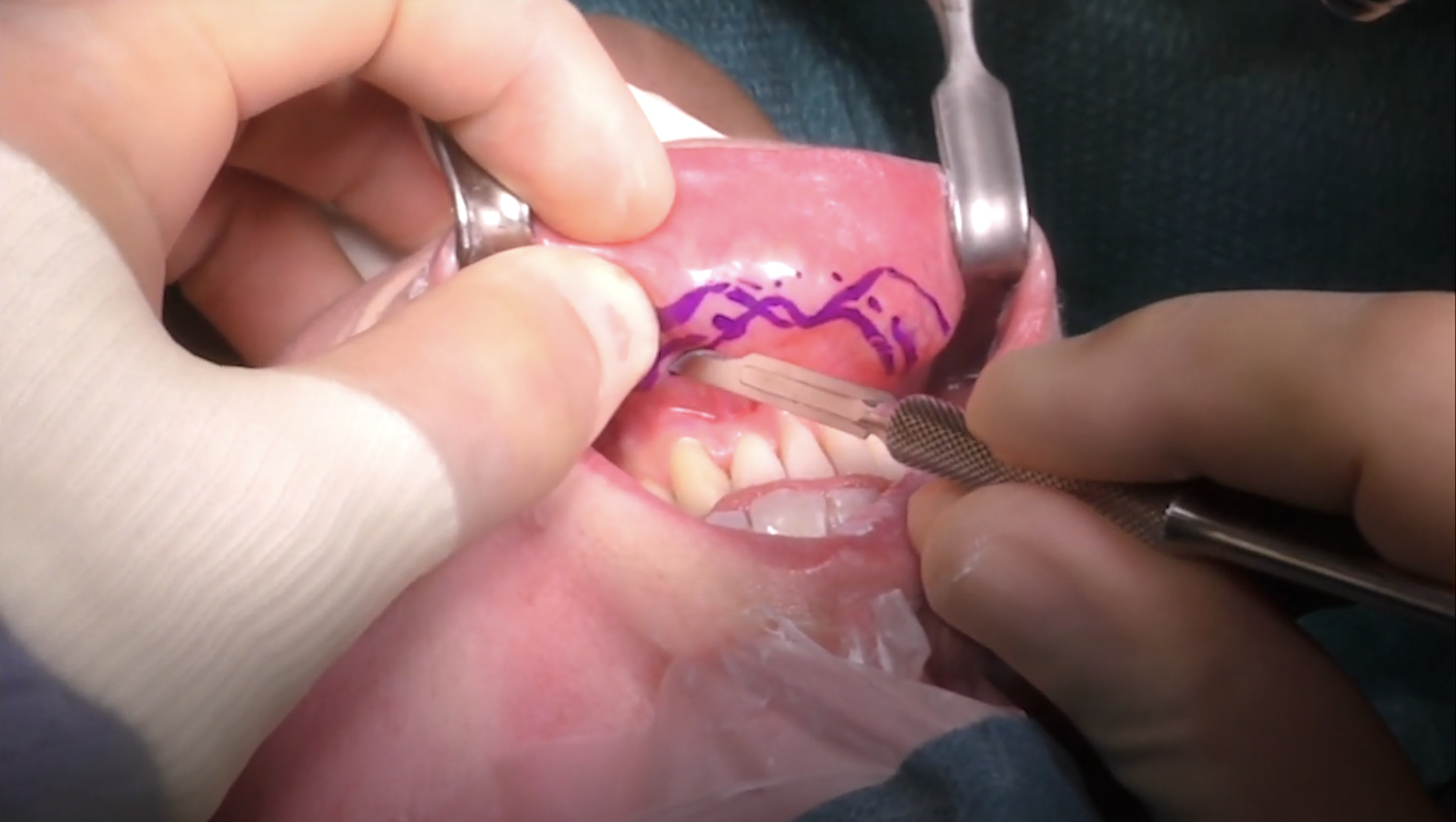 Sliding genioplasty (2019)