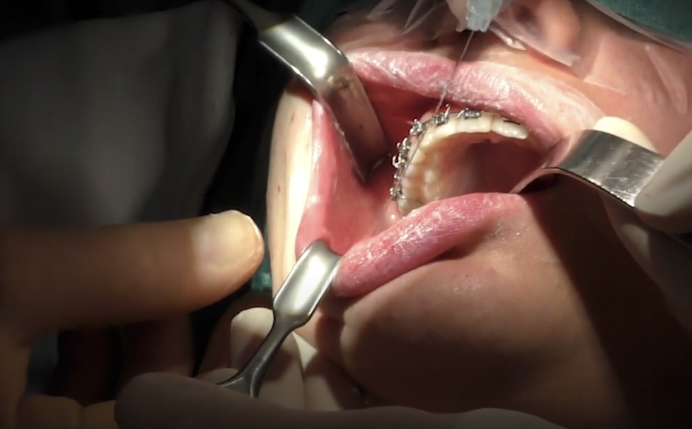 Endoscopic Bilateral Sagittal Split Osteotomy