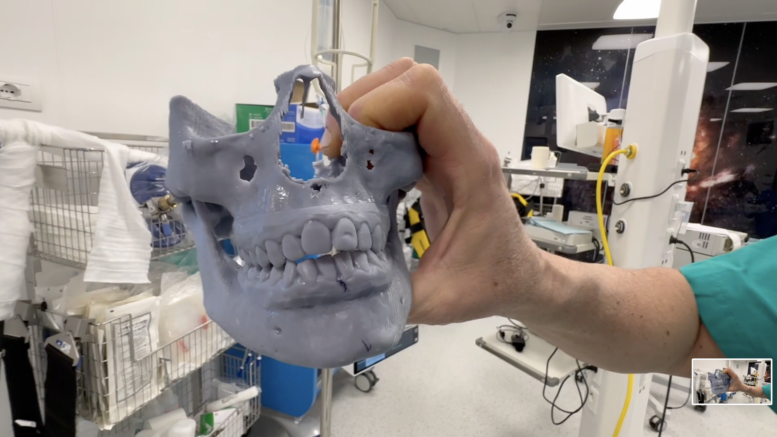 Slice functional condylectomy – Piero Cascone