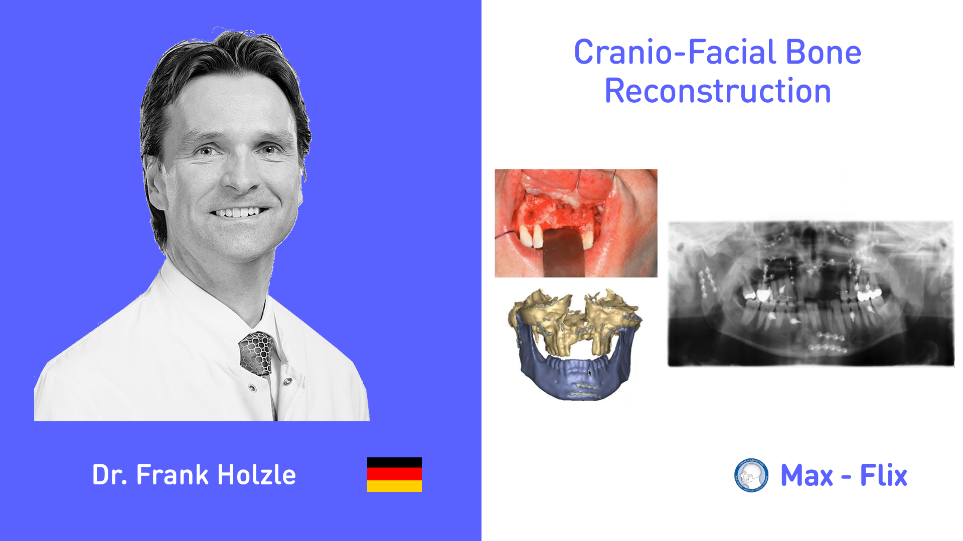 Cranio-Facial Bone Reconstruction