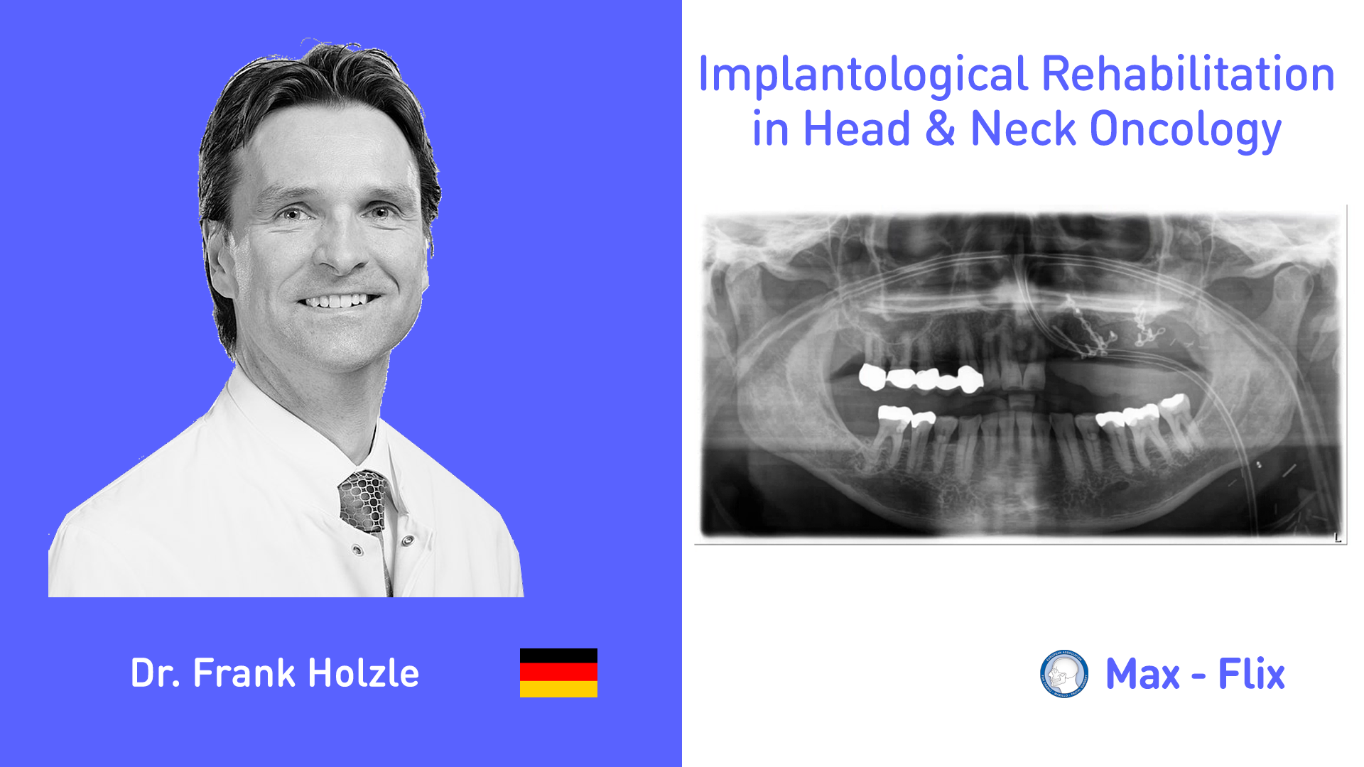 Implantological Rehabilitation in Head & Neck Oncology