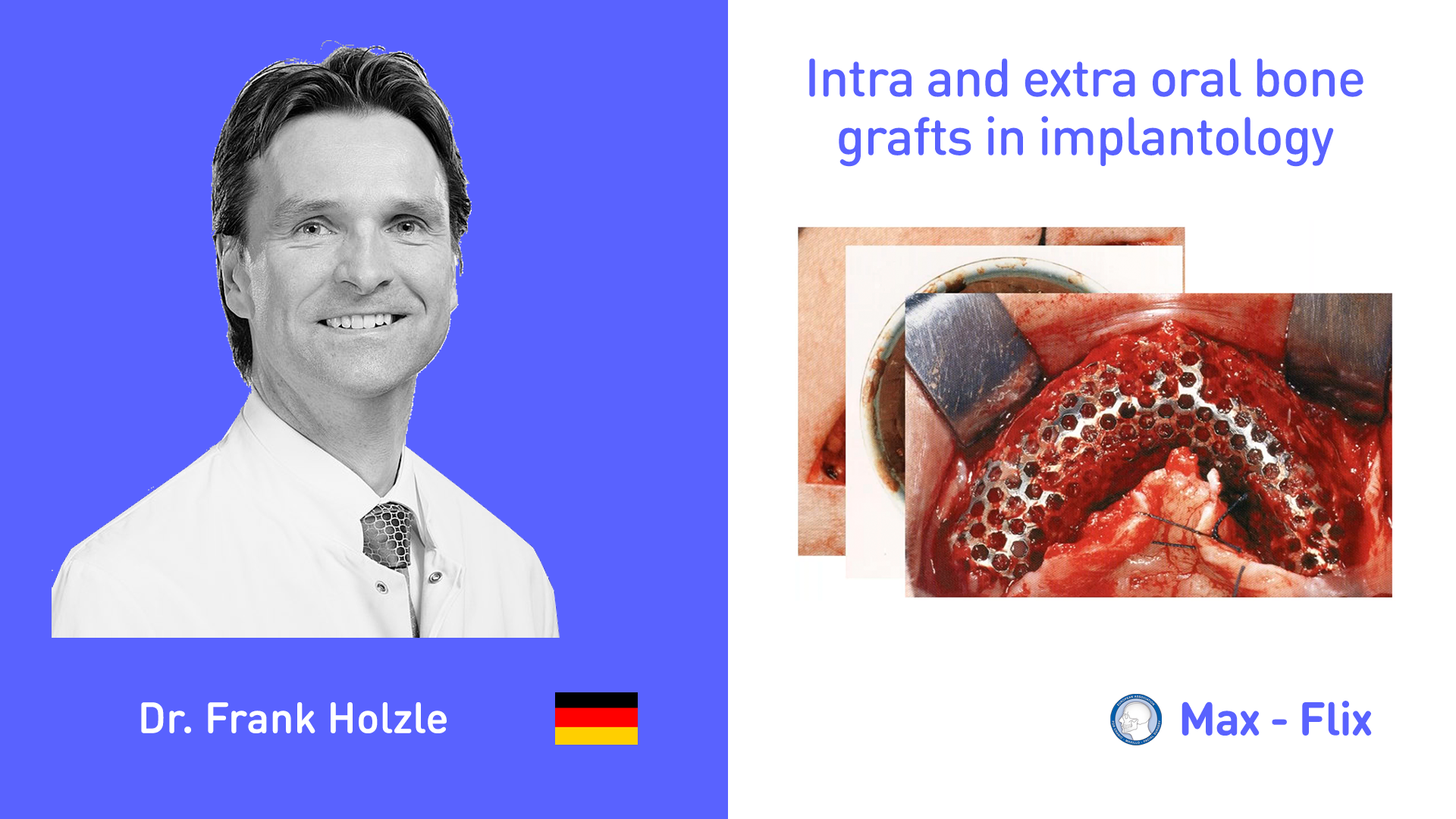 Intra and extra oral bone grafts in implantology