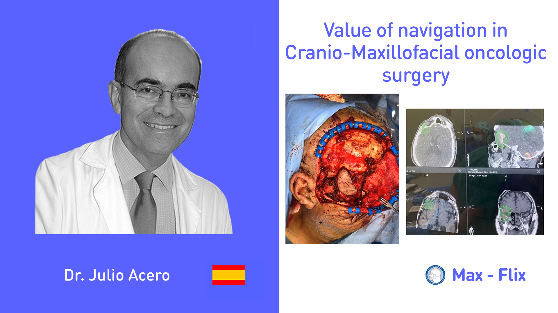 Value of navigation in Cranio-Maxillofacial oncologic surgery