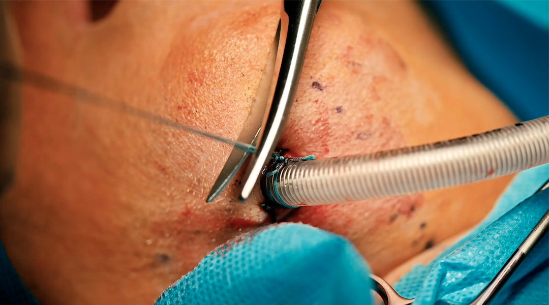 Submental Intubation – Dr. Aurelien Louvrier