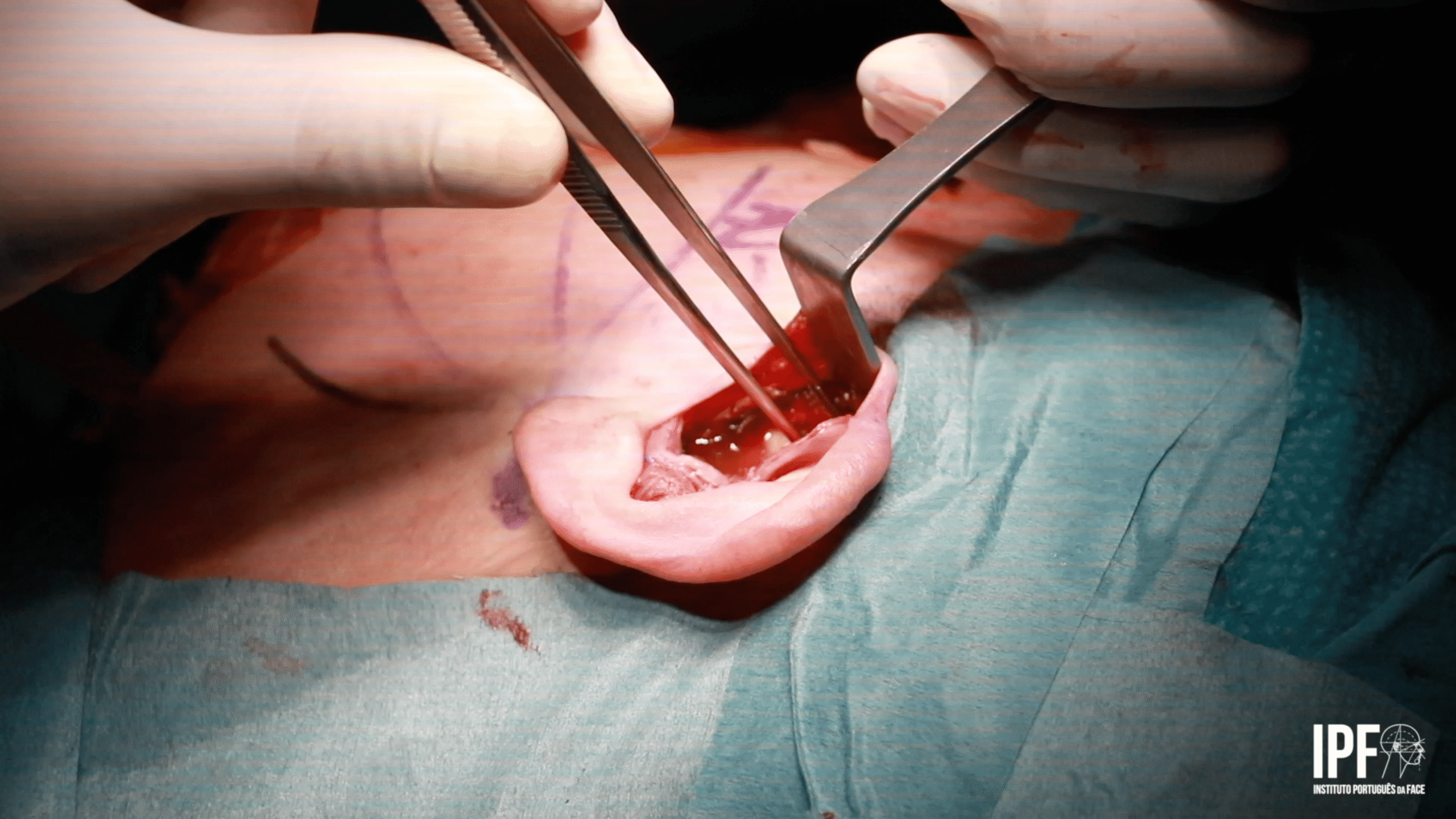 TMJ Open Surgery – Dr. David Angelo