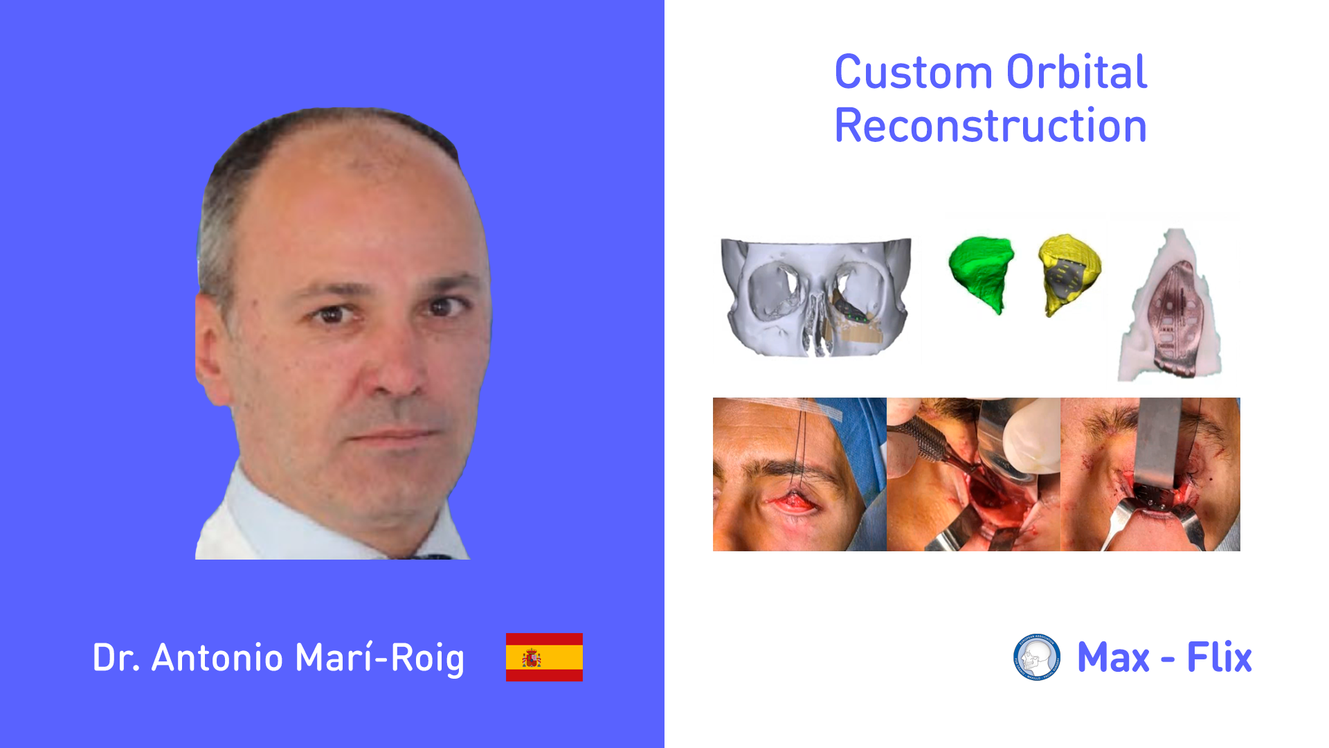 CUSTOM ORBITAL RECONSTRUCTION