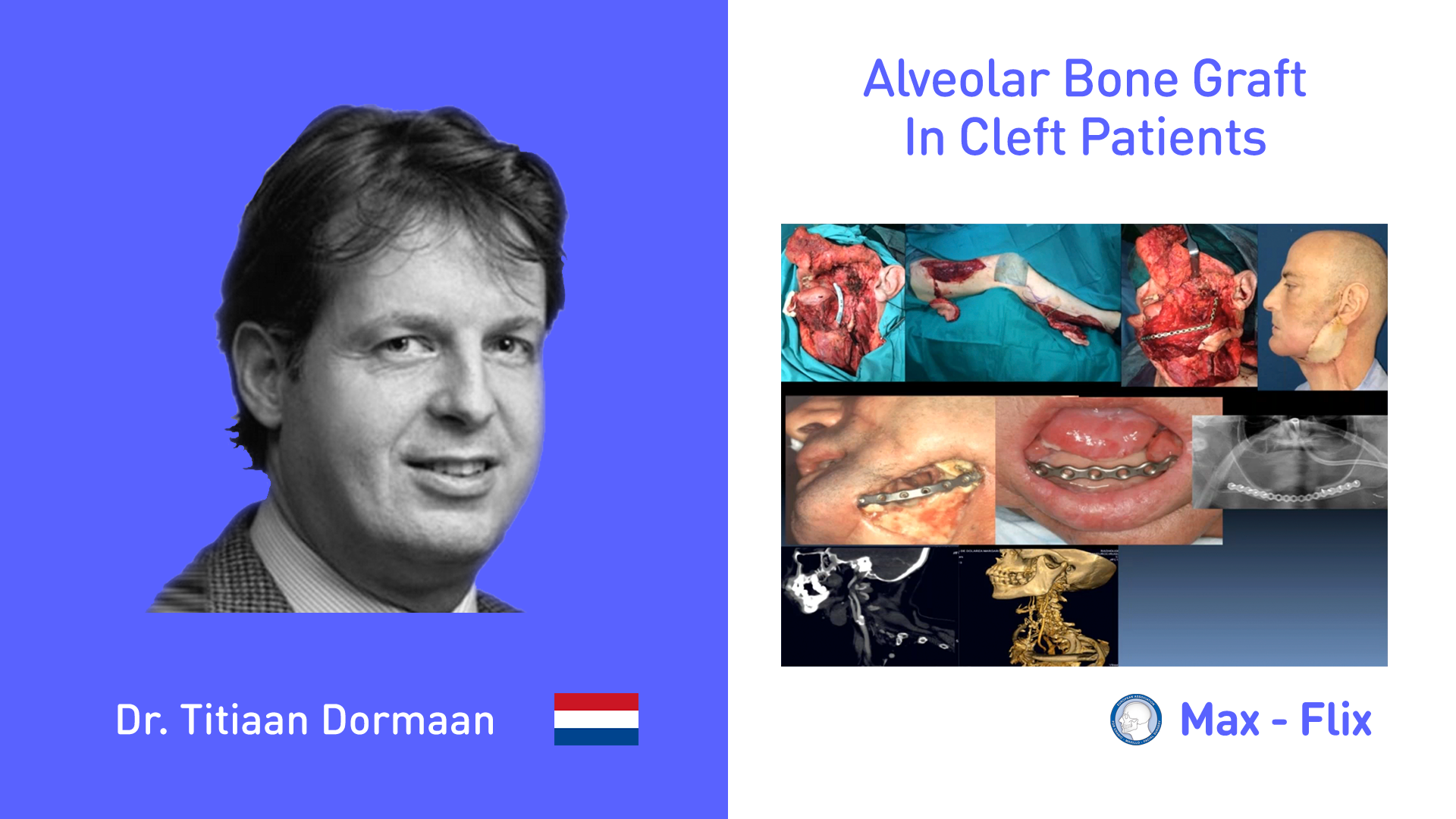 Alveolar Bone Graft In Cleft Patients