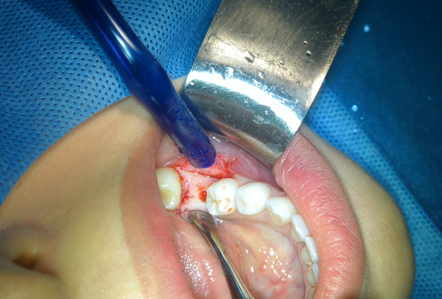 Implant Placement Step By Step – Dr. Renato Isufi